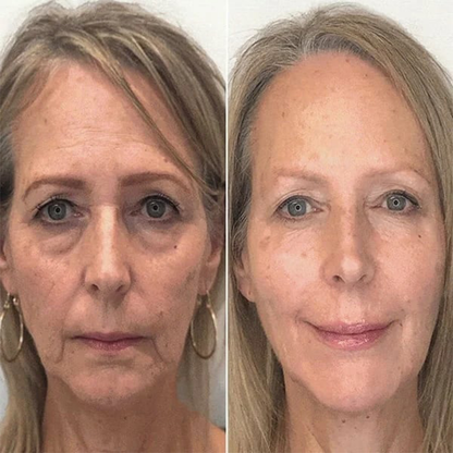 🔥Full refund if no effect after use🔥2026, Exclusive premium Suiiao COMPLEX technology and sophisticated design 2-minute wrinkle-reducing serum