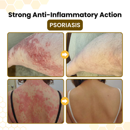 NATRAVOR® PsoriaSoothe Bee Venom Skin-Restoration Cream