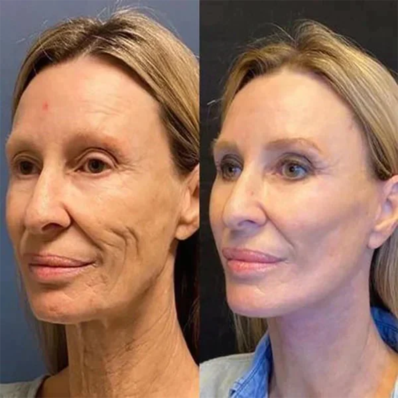 🔥Full refund if no effect after use🔥2026, Exclusive premium Suiiao COMPLEX technology and sophisticated design 2-minute wrinkle-reducing serum